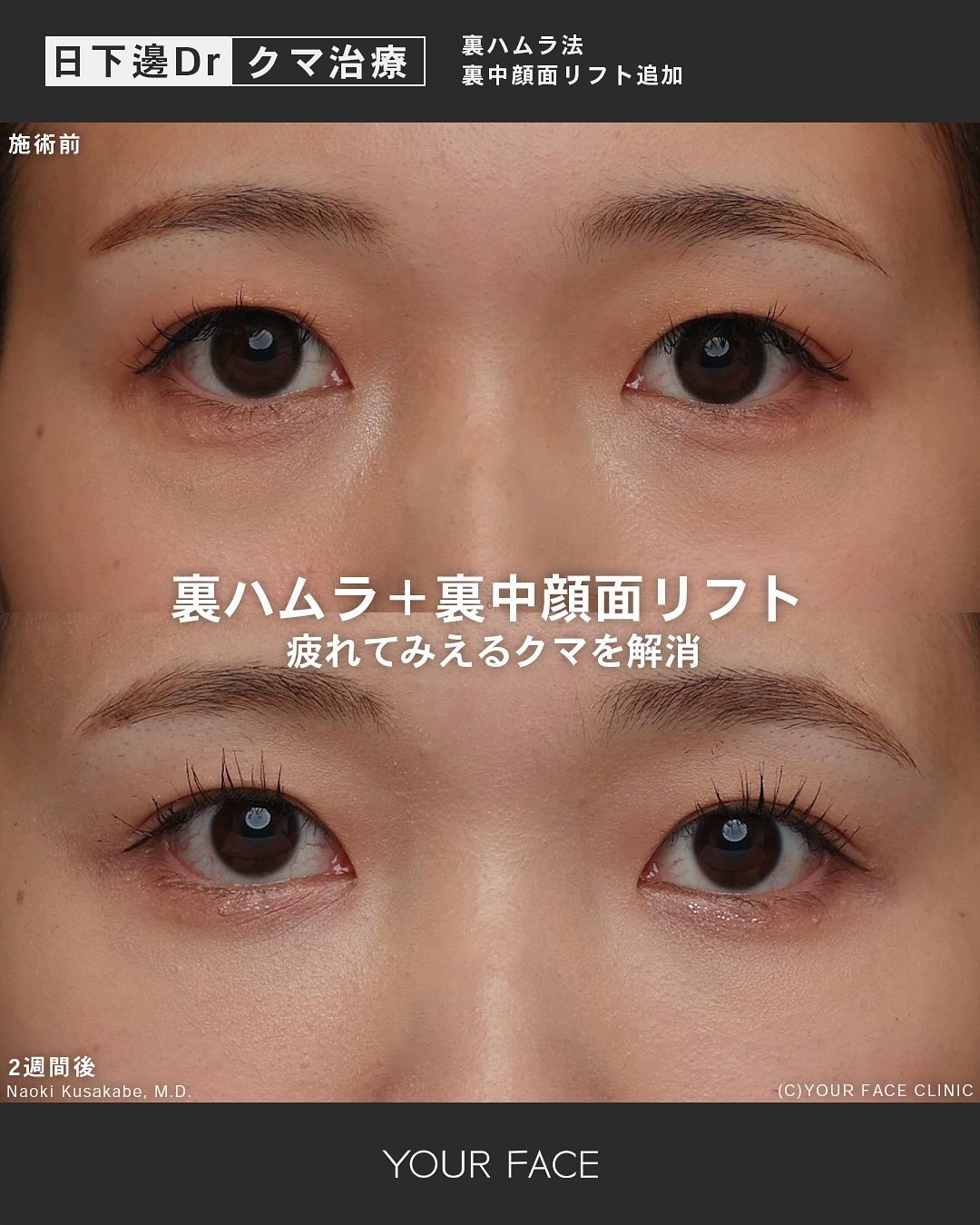 裏ハムラ・中顔面リフト