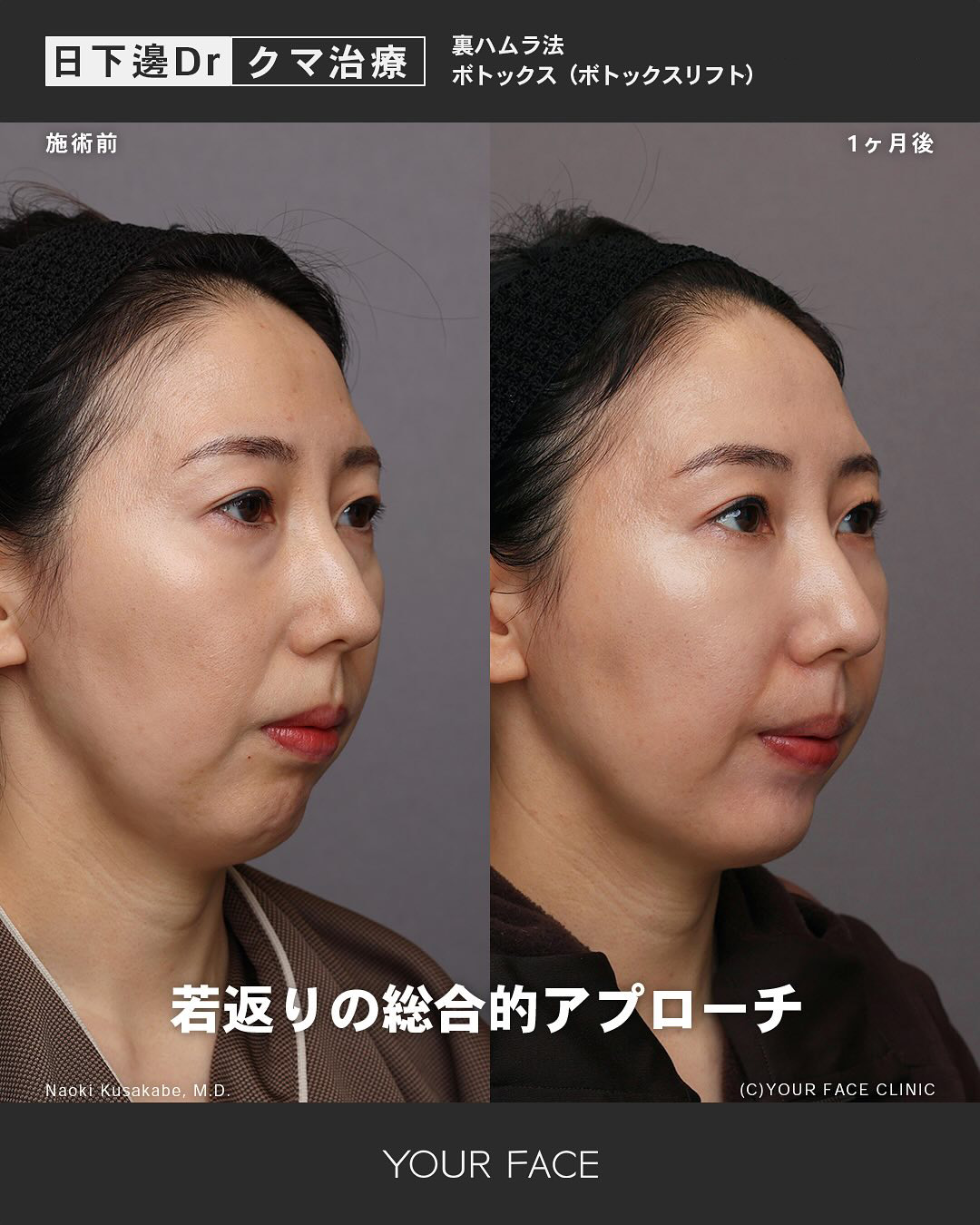 裏ハムラ・ボトックス