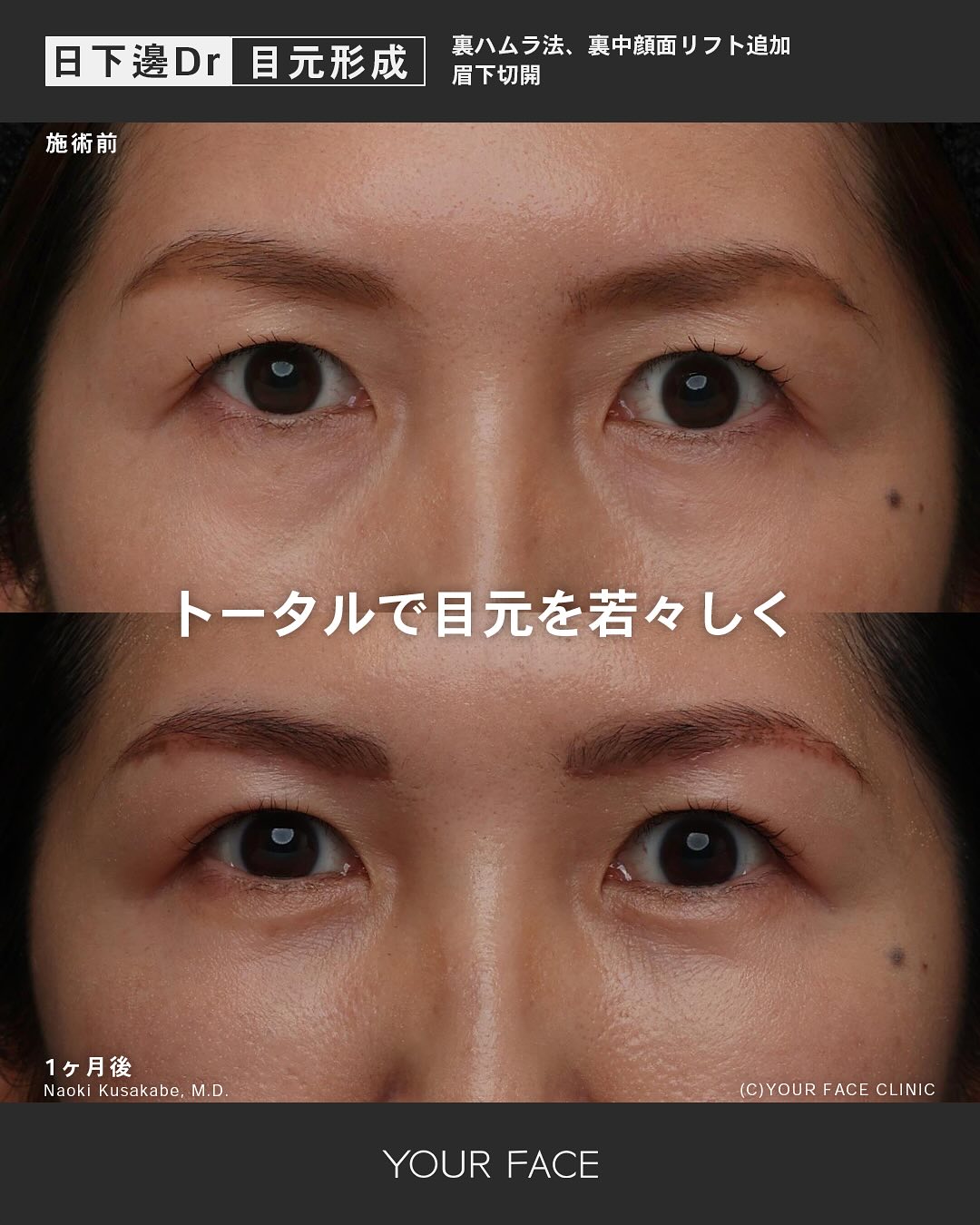 眉下切開・裏ハムラ・中顔面リフト