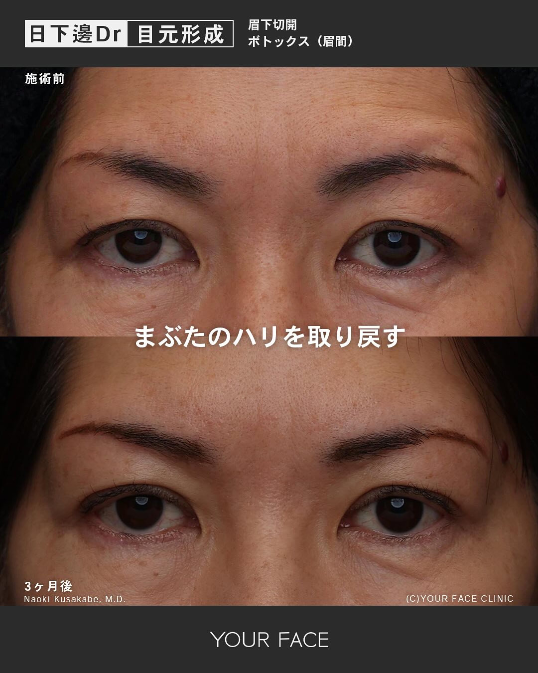 眉下切開・ボトックス