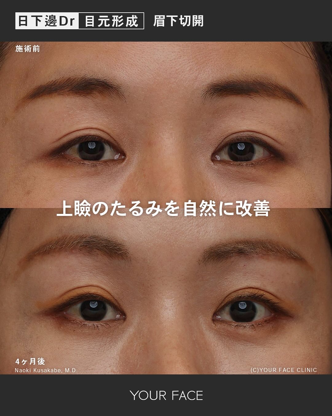 眉下切開