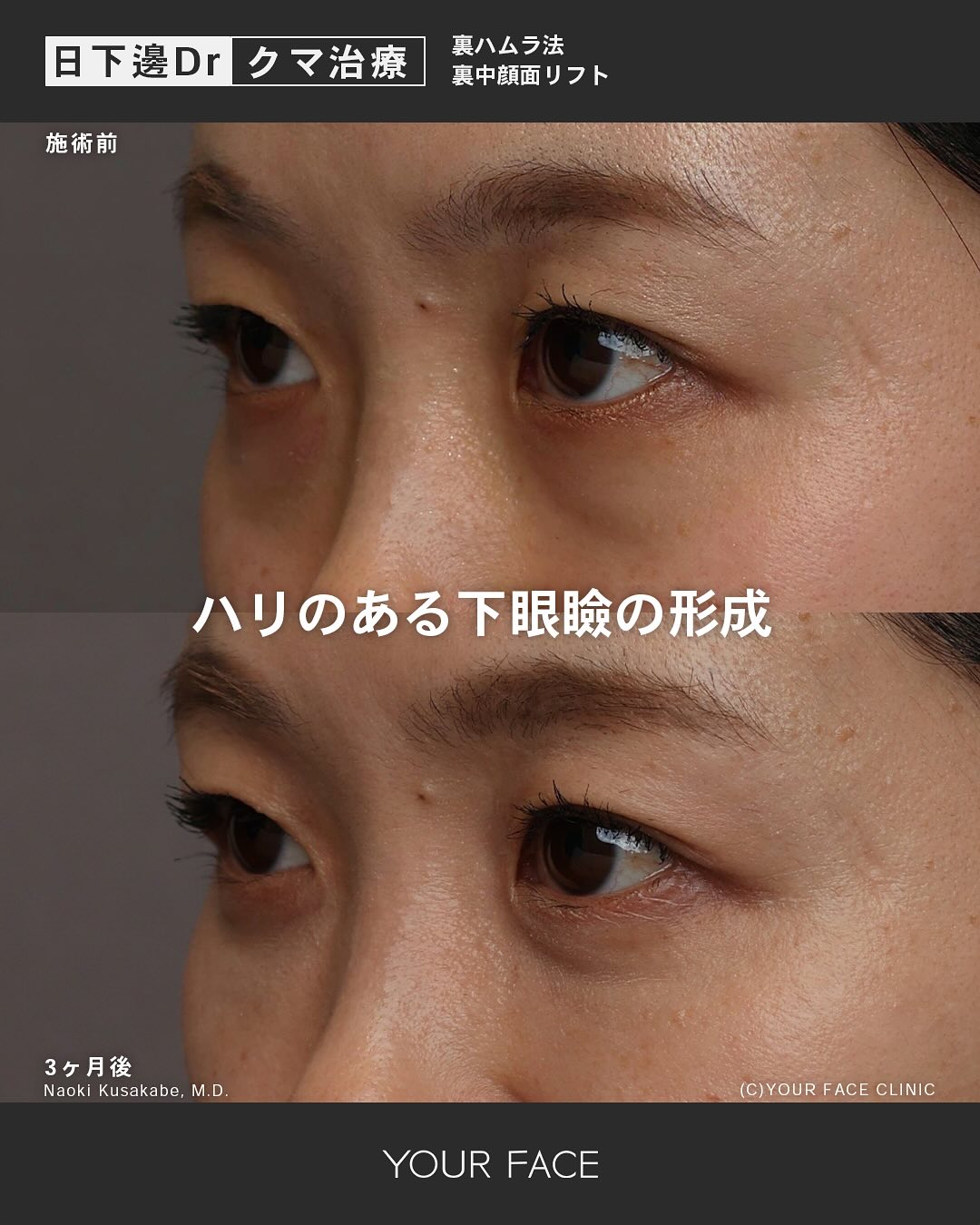 裏ハムラ・中顔面リフト