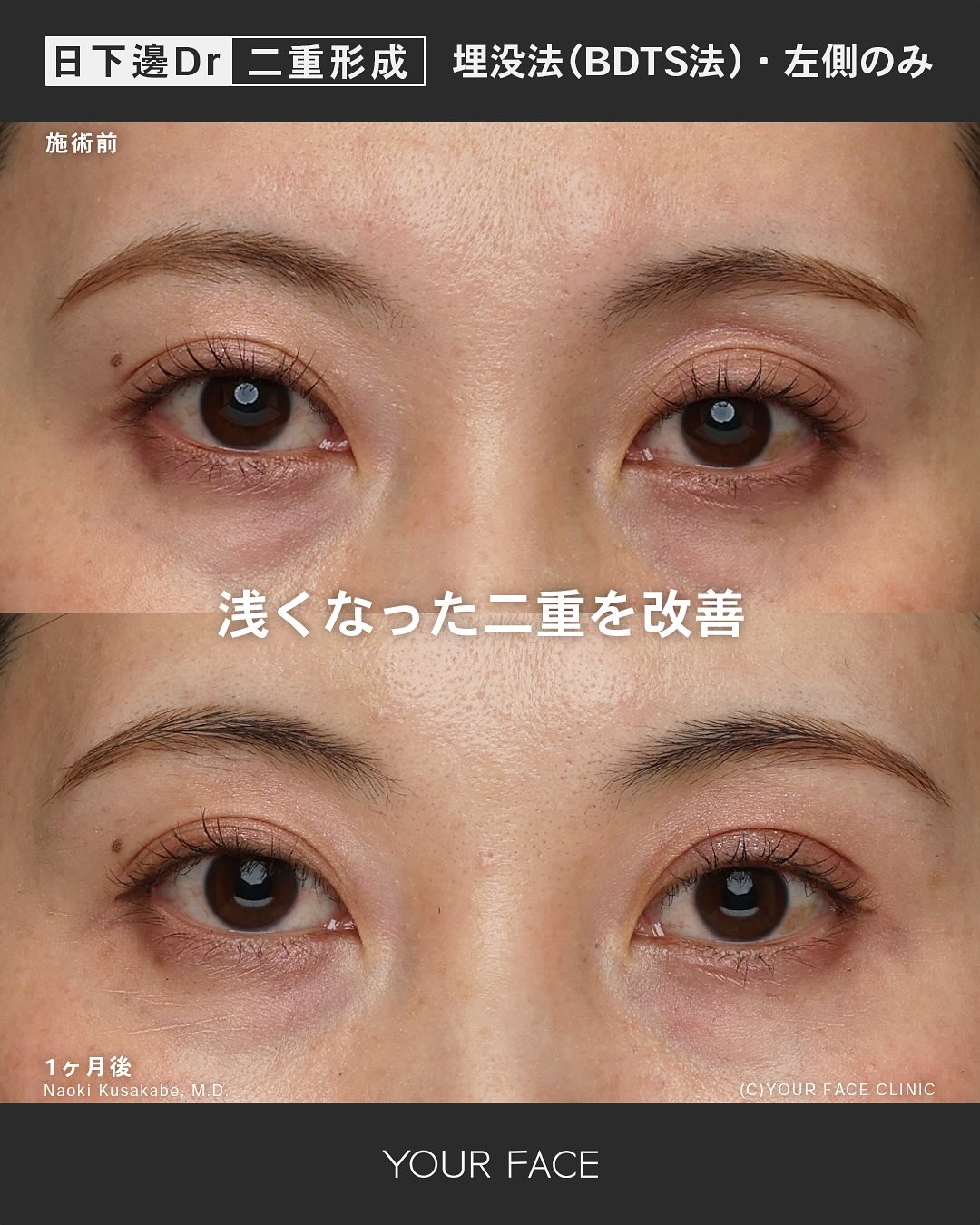 二重埋没