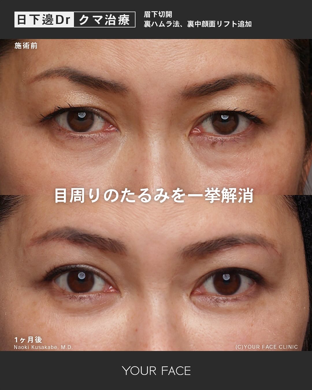 眉下切開・裏ハムラ・中顔面リフト