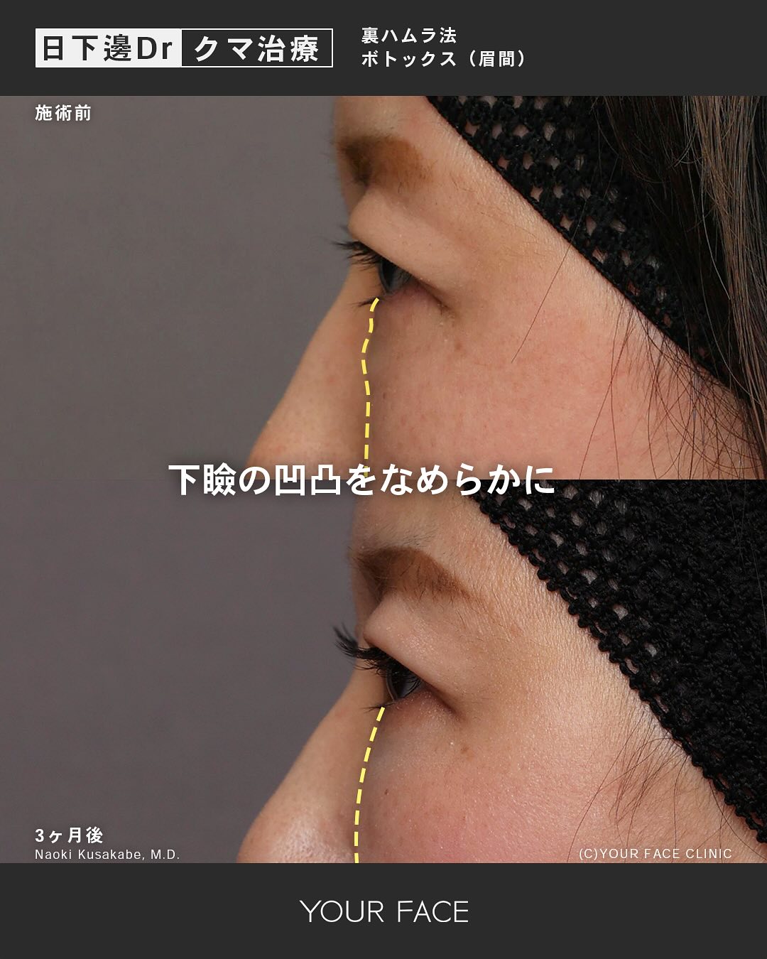 裏ハムラ・ボトックス