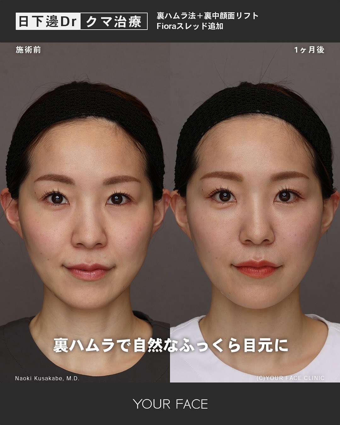 裏ハムラ・裏中顔面リフト