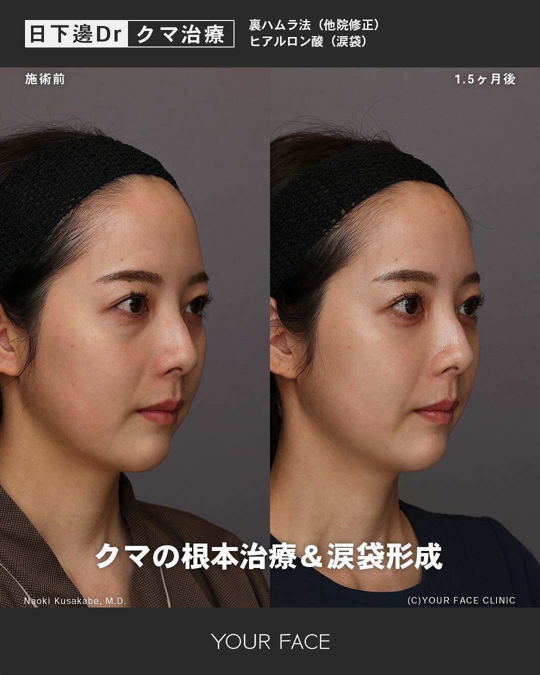 裏ハムラ・糸リフト・ヒアルロン酸