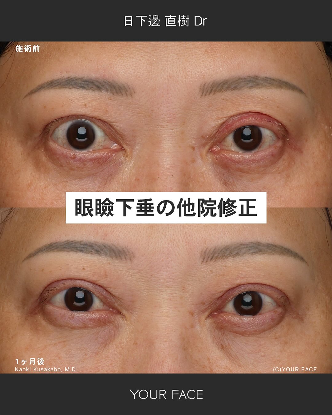 眼瞼下垂 他院修正