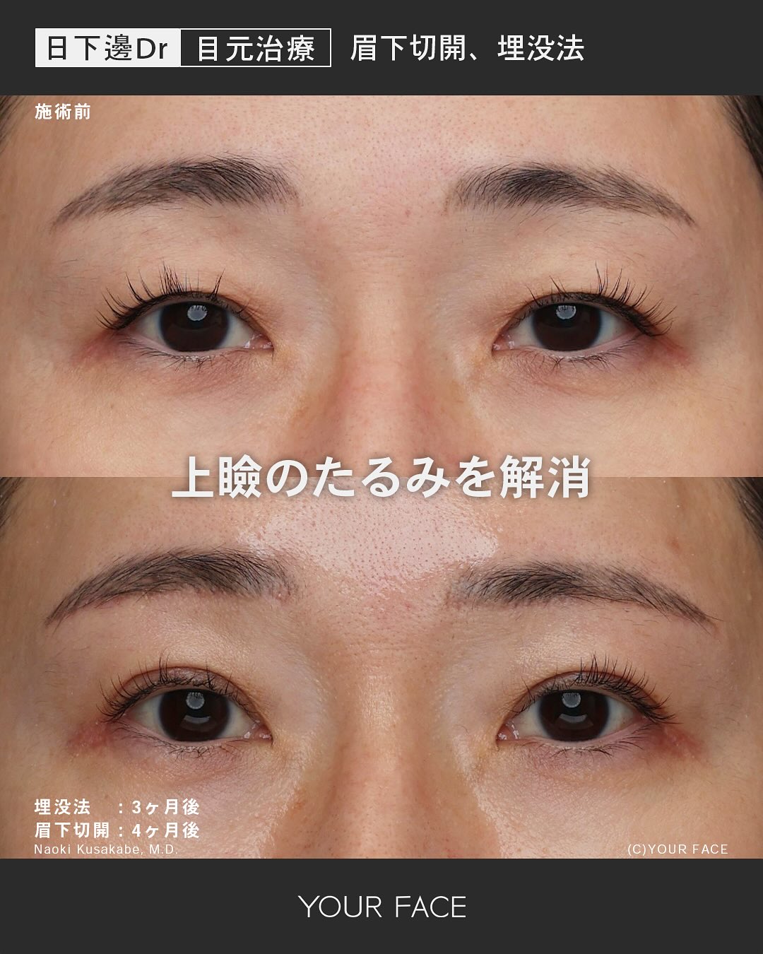 埋没法・眉下切開