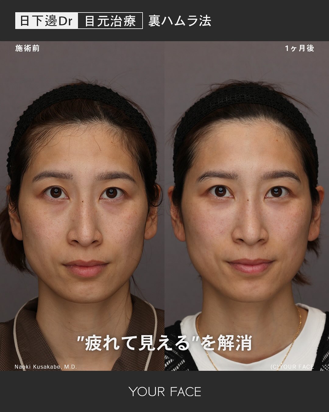 裏ハムラ・裏中顔面リフト