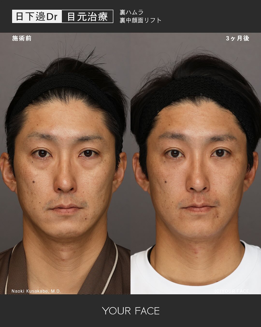 裏ハムラ・糸リフト・裏中顔面リフト