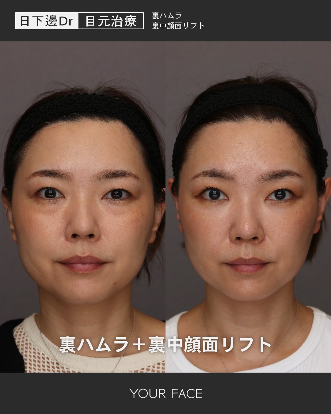 裏ハムラ・裏中顔面リフト