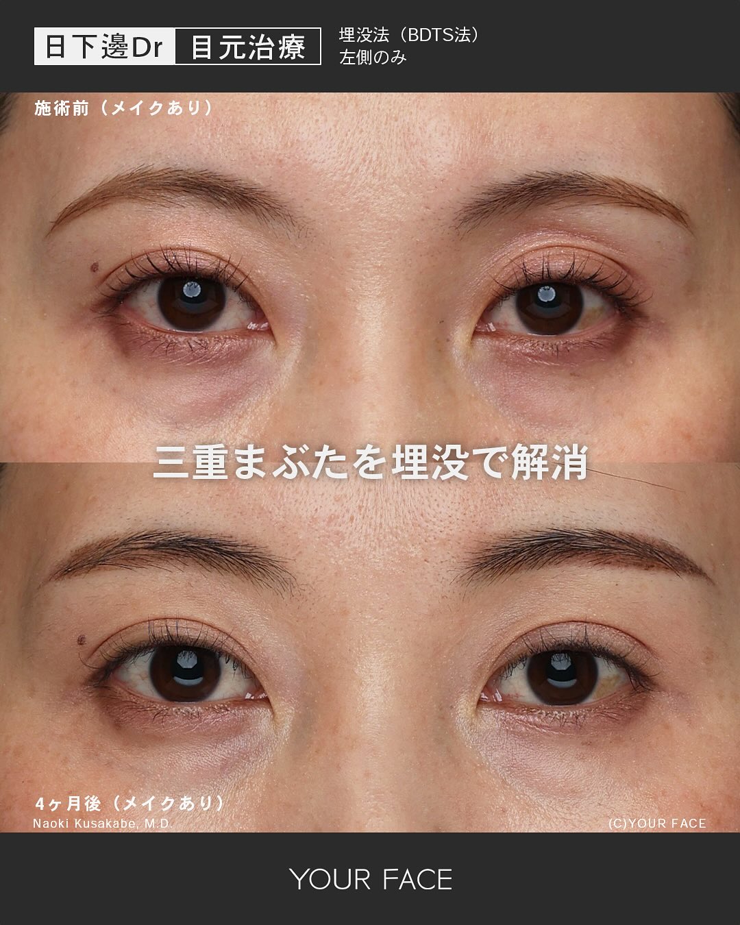 埋没法