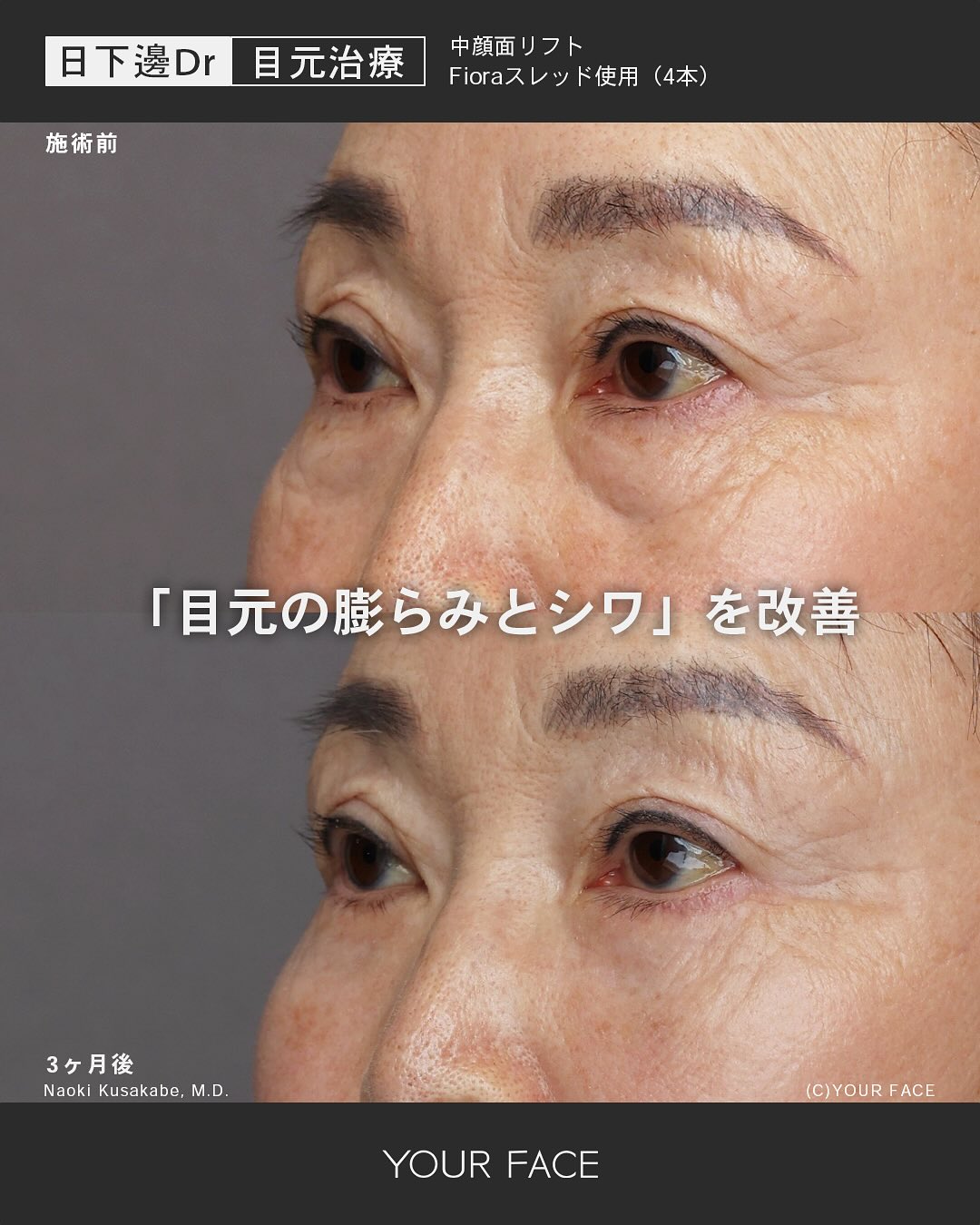 表ハムラ・糸リフト