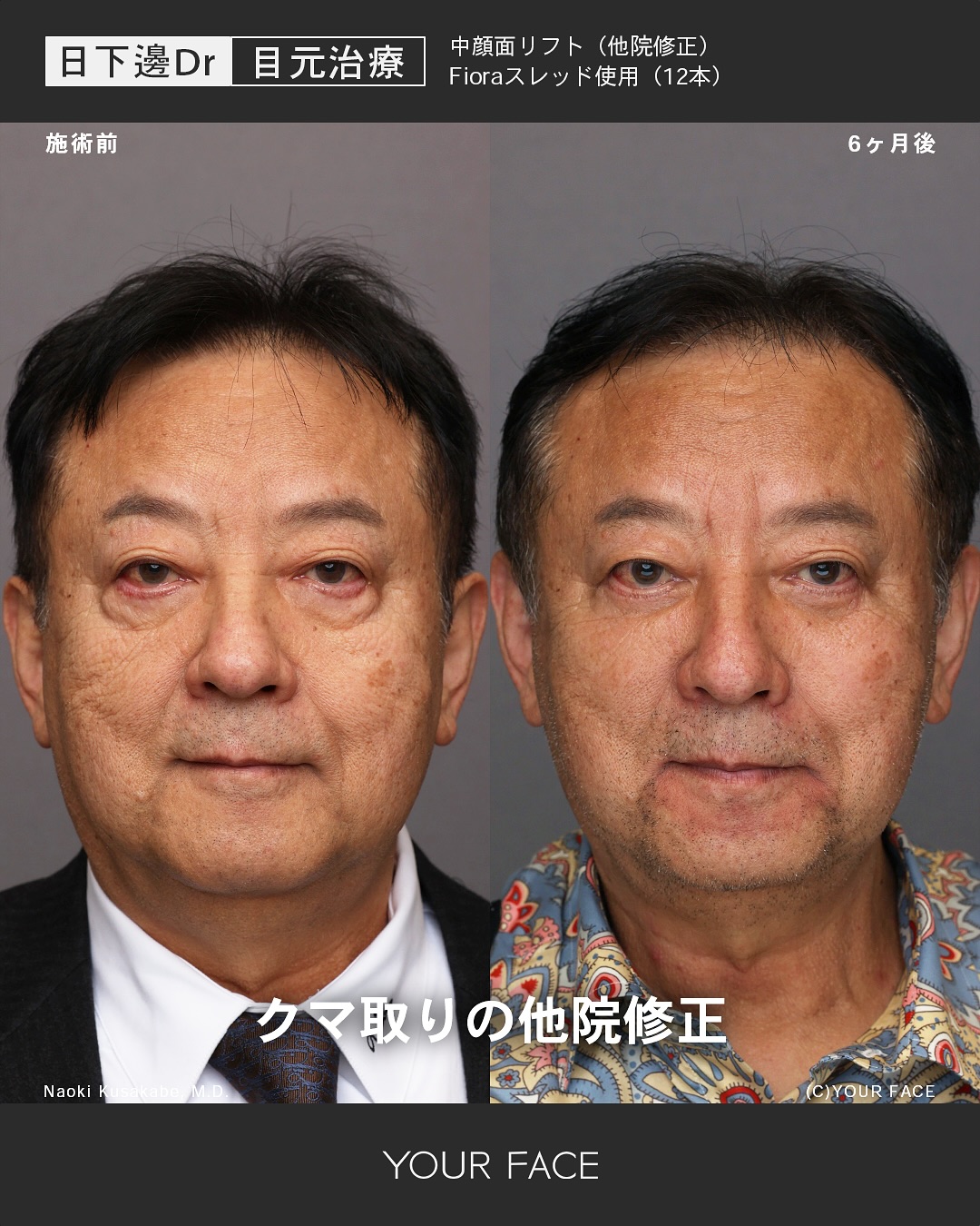 表ハムラ・糸リフト