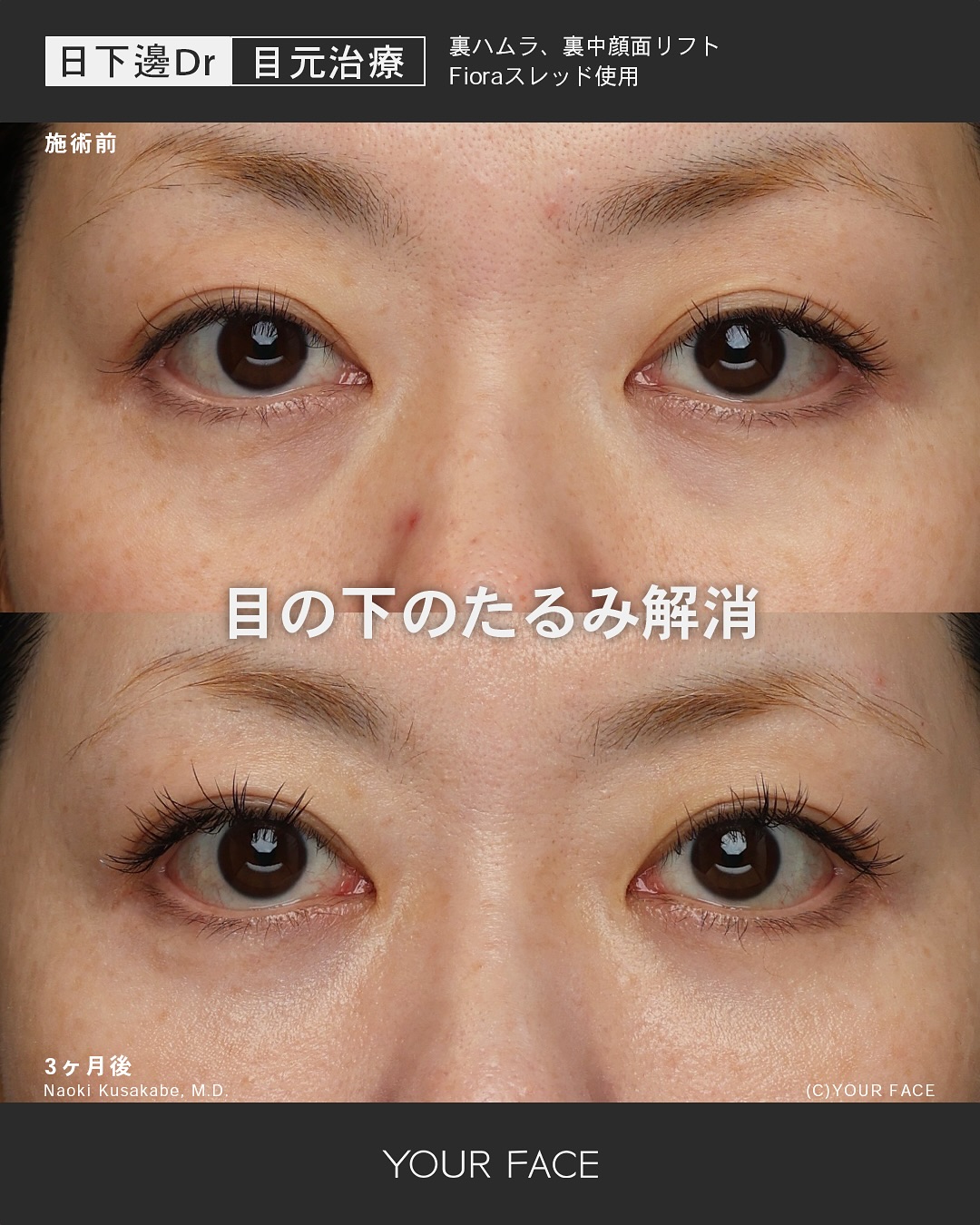 裏ハムラ・裏中顔面リフト
