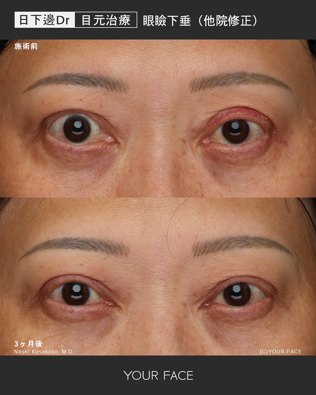 眼瞼下垂 他院修正