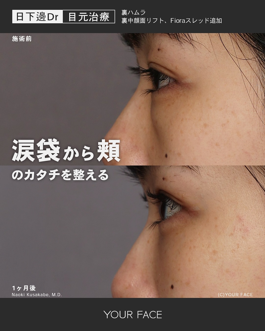 裏ハムラ・糸リフト・裏中顔面リフト