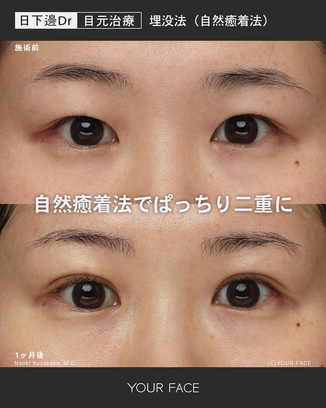 二重埋没