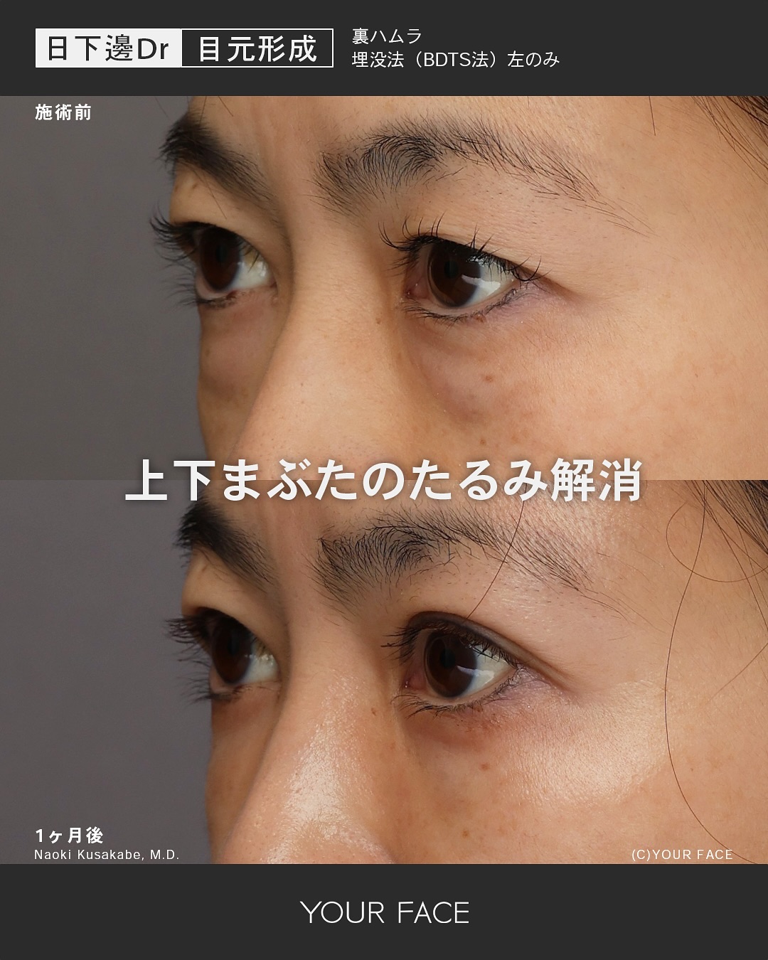 裏ハムラ・二重埋没