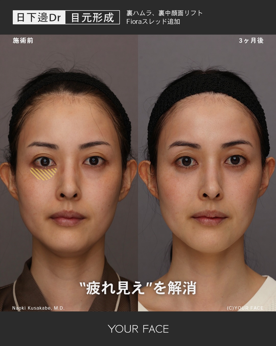 裏ハムラ・糸リフト・中顔面リフト