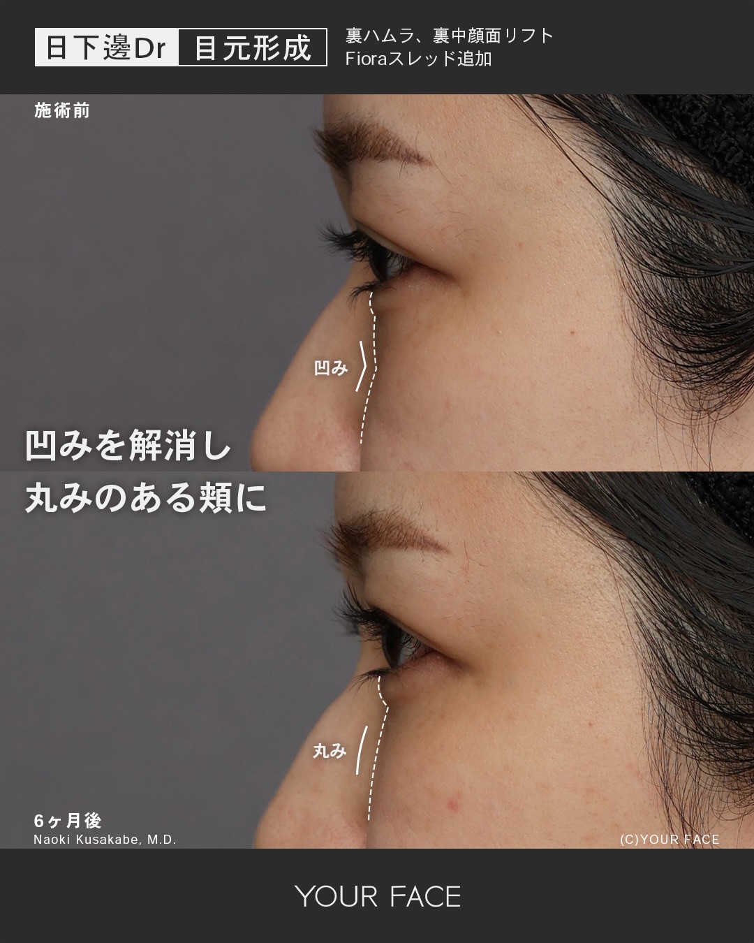 裏ハムラ・糸リフト・中顔面リフト