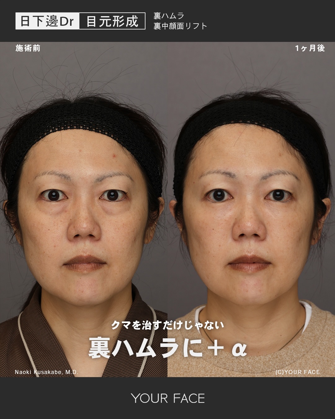 裏ハムラ・中顔面リフト