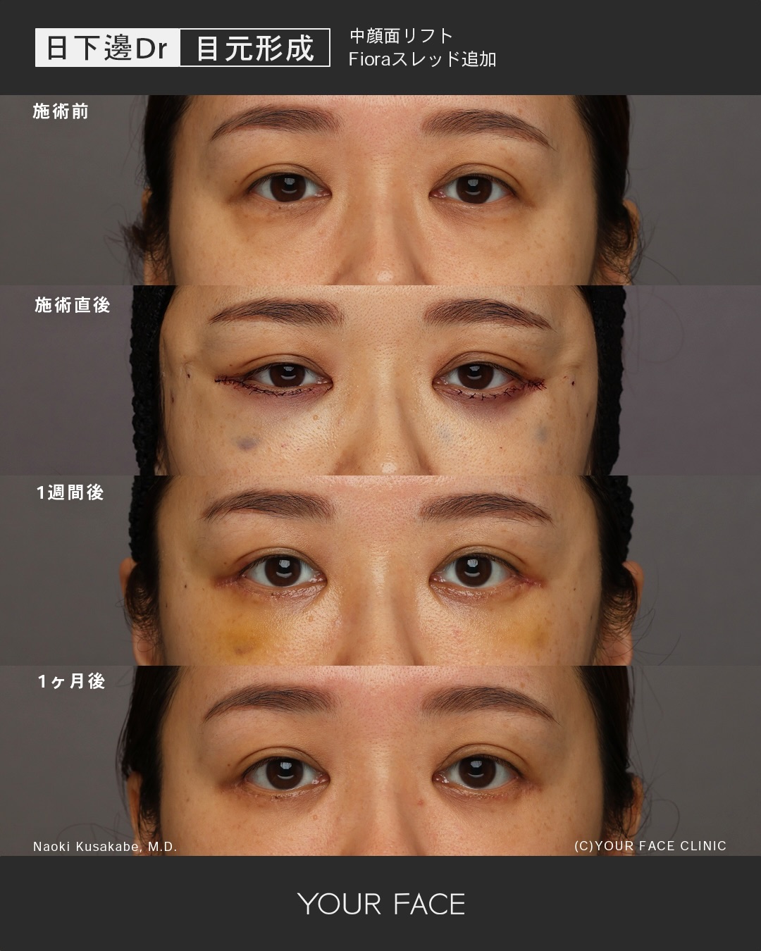 中顔面リフト・糸リフト