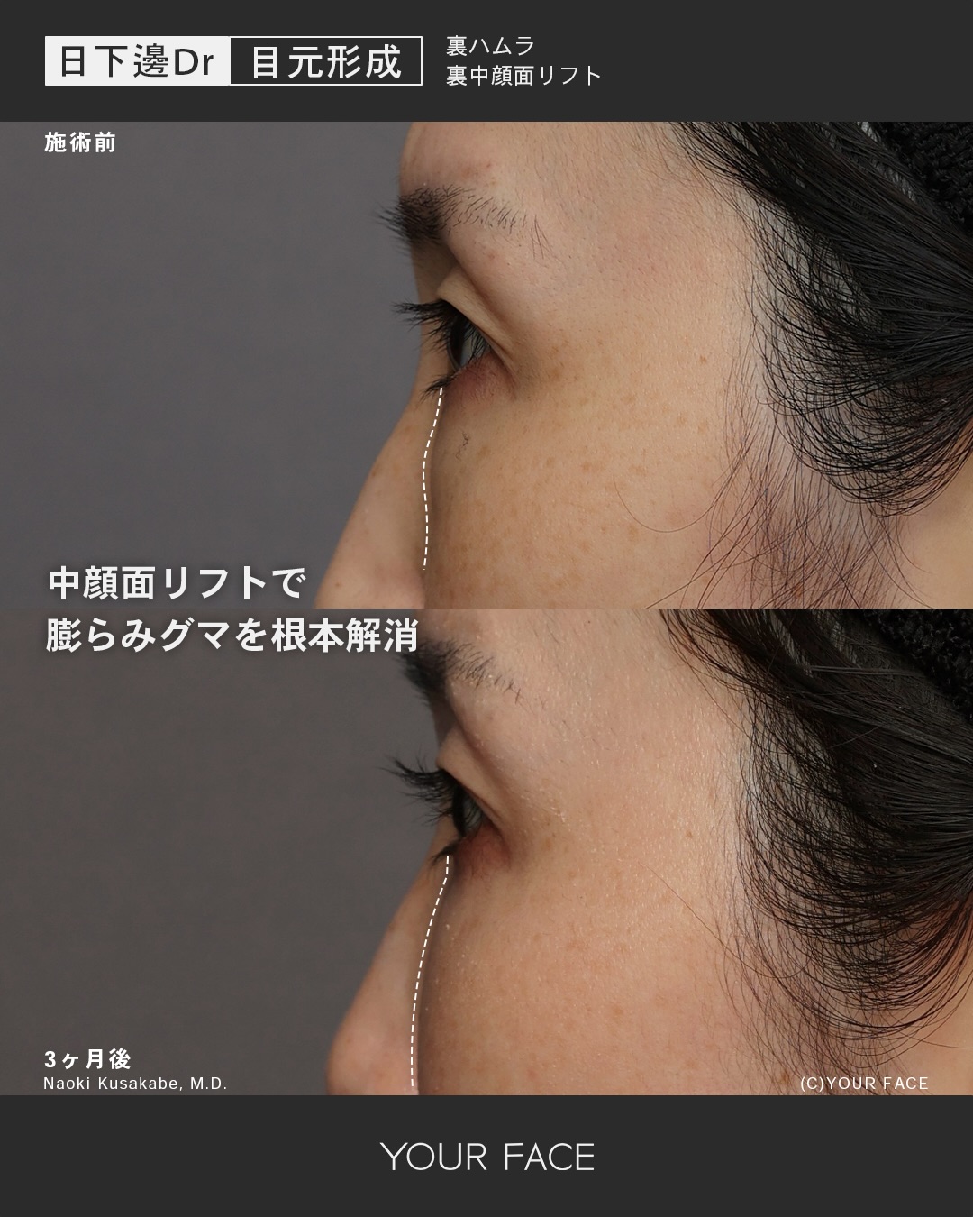 裏ハムラ・中顔面リフト