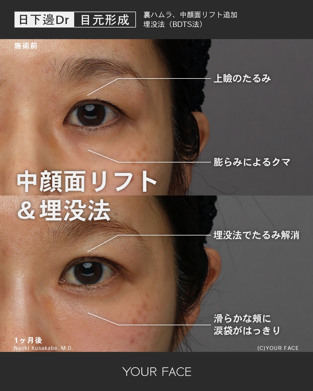 裏ハムラ・中顔面リフト・二重埋没