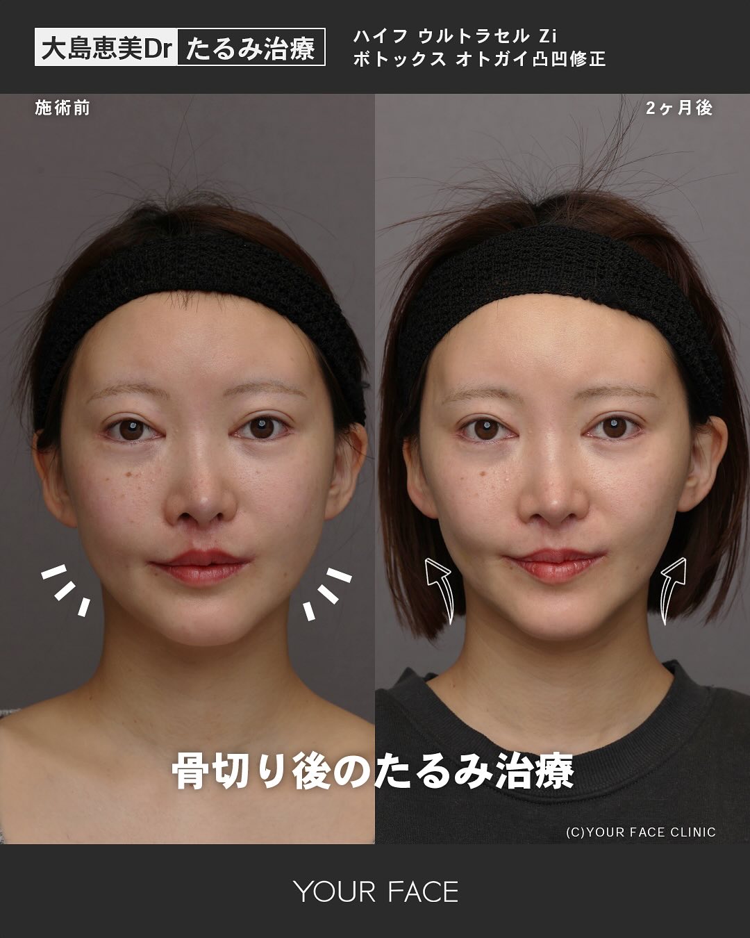 骨切り後のたるみ治療