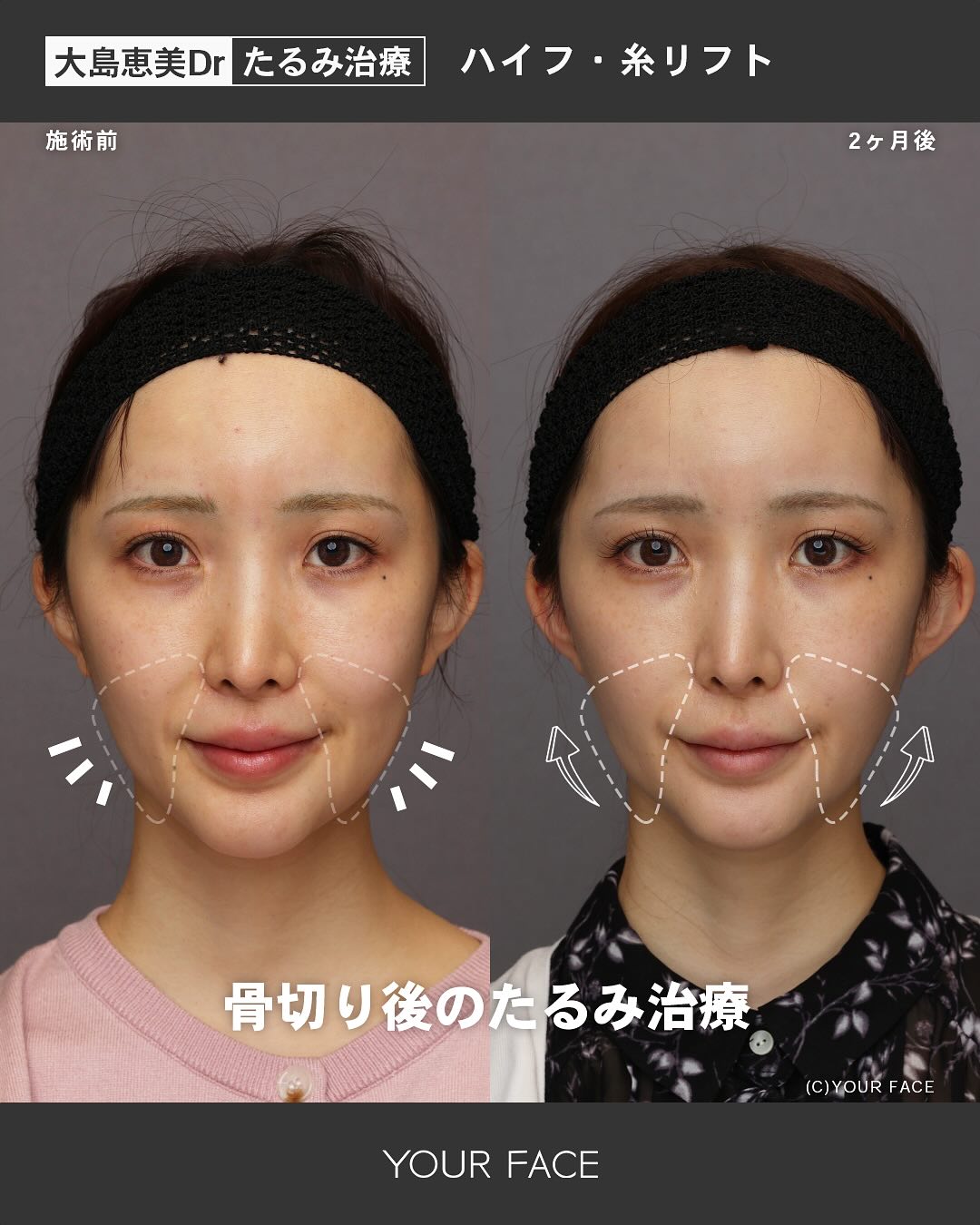 骨切り後のたるみ治療