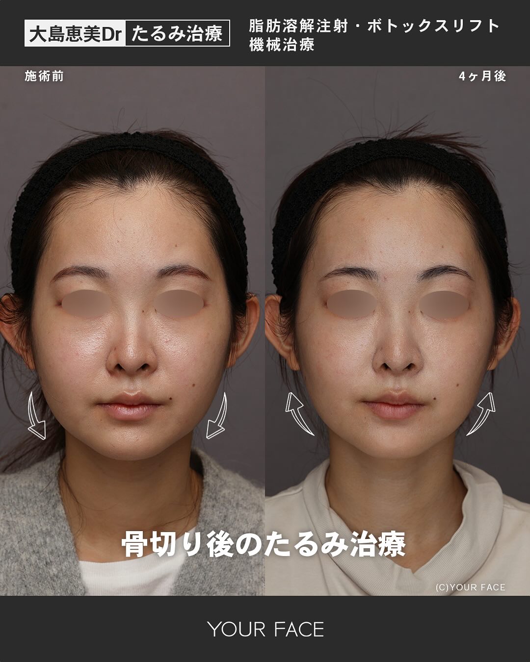 骨切り後のたるみ治療