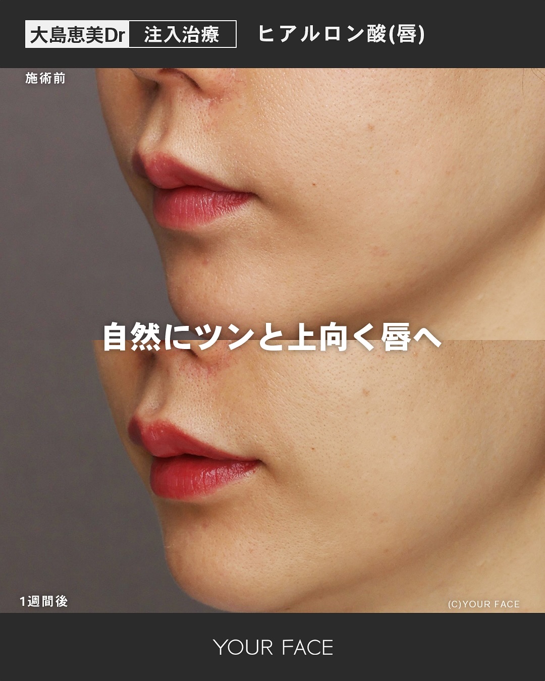 ヒアルロン酸
