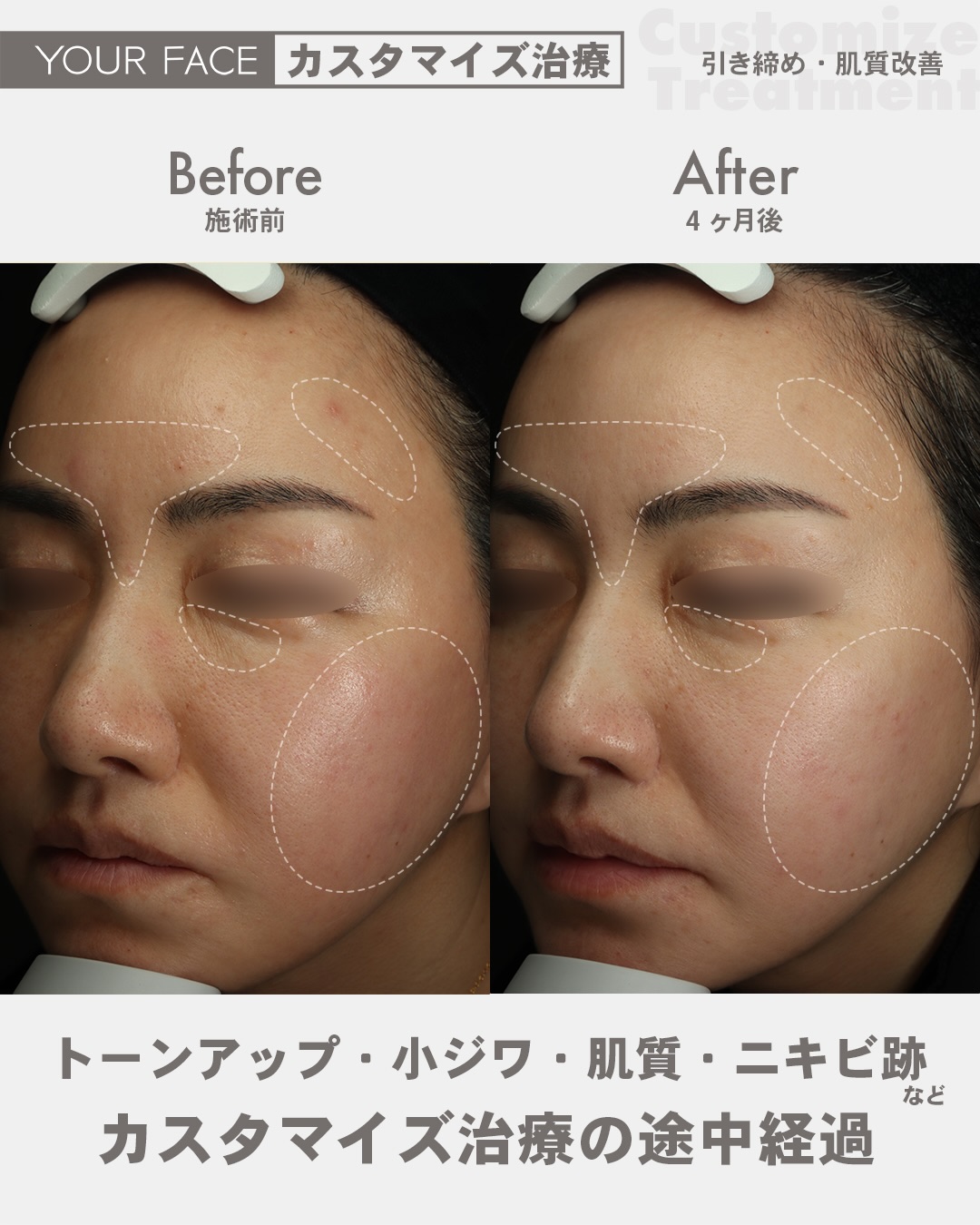 カスタマイズ治療