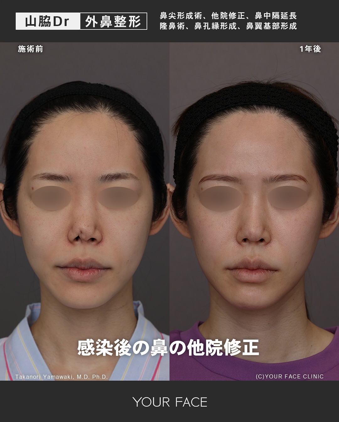 鼻 他院修正
