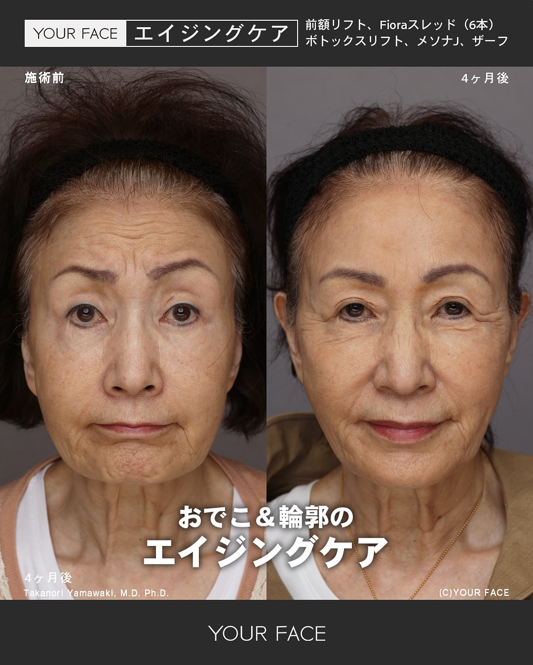 エイジングケア