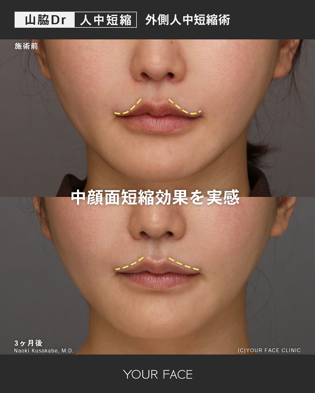 外側人中短縮