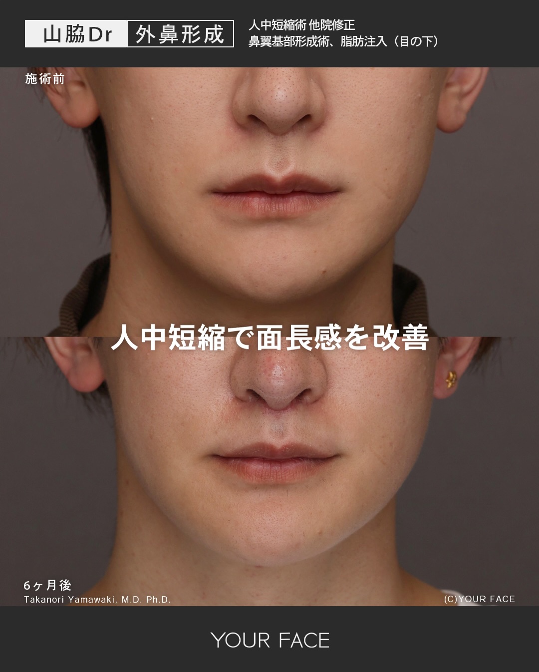 人中短縮 他院修正・鼻