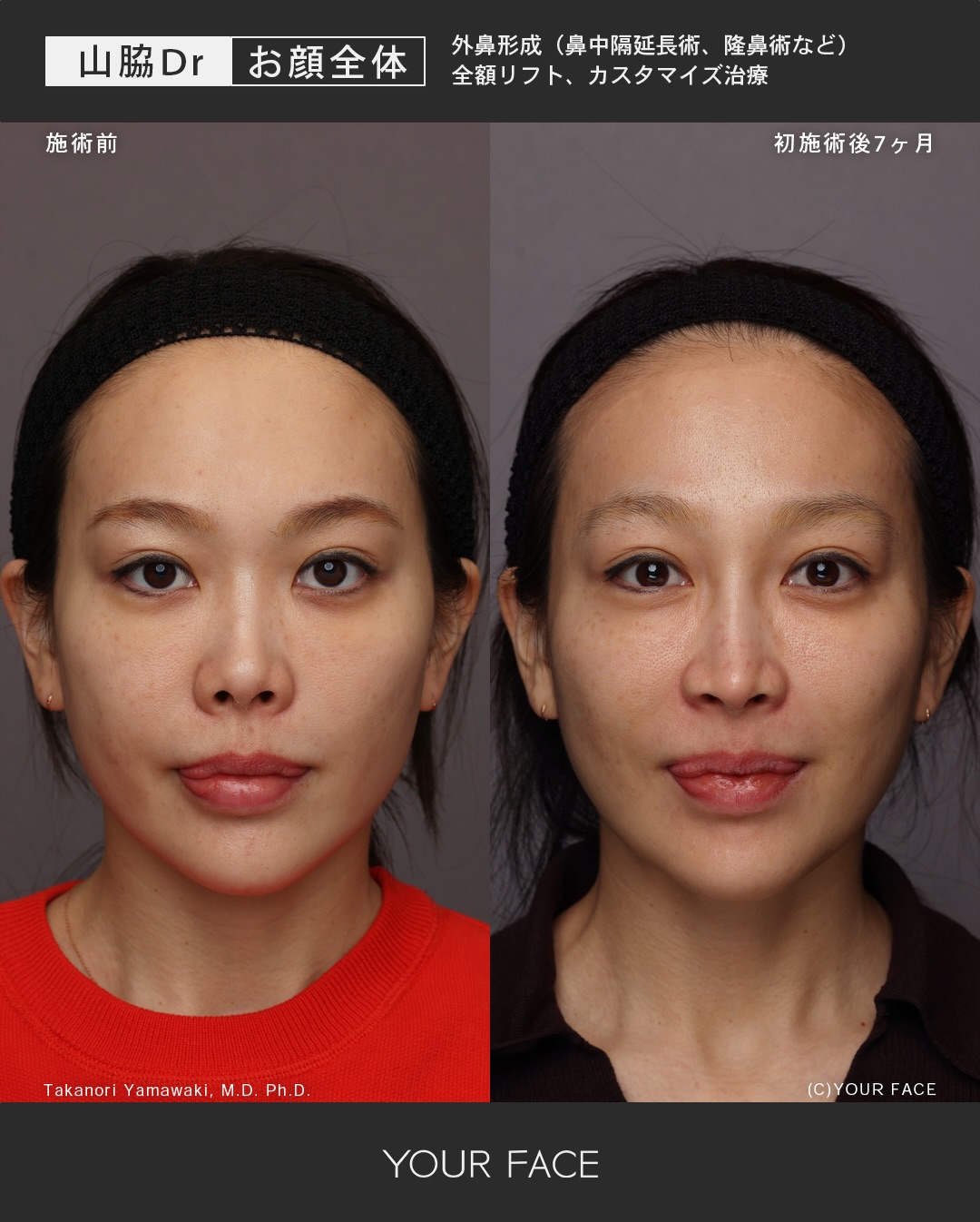 鼻・前額リフト・カスタマイズ治療