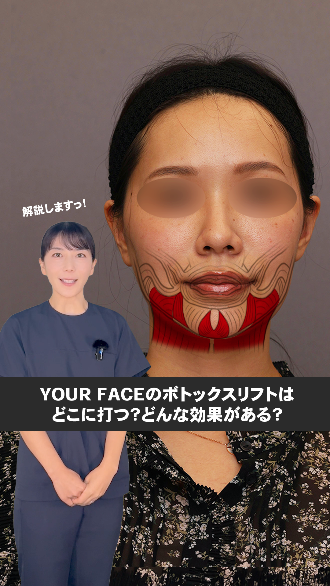 ボトックス動画のサムネイル